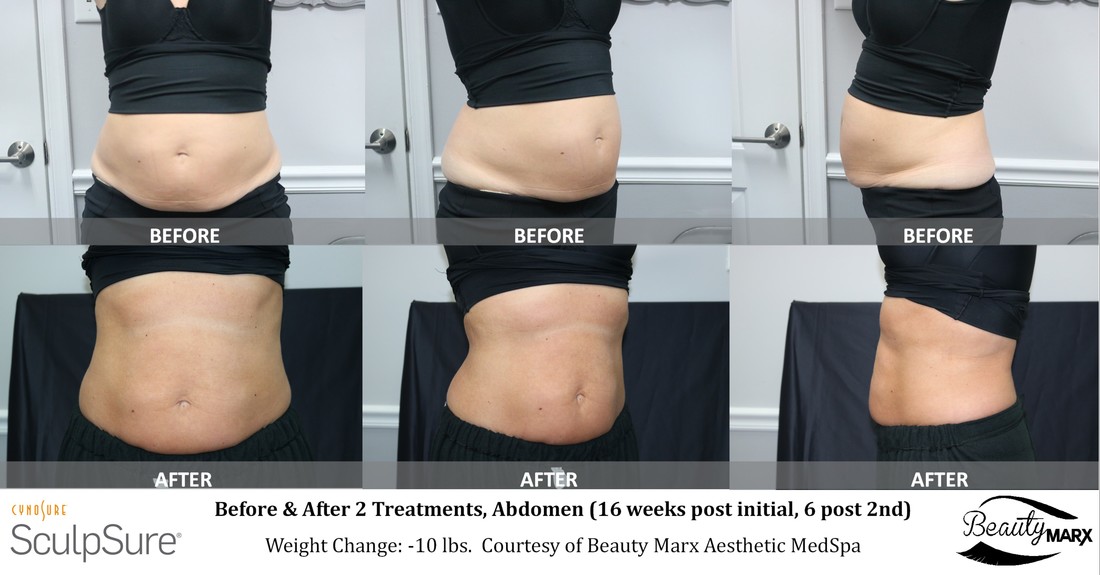 SculpSure Body Contouring Treatment - Dermatology Services In